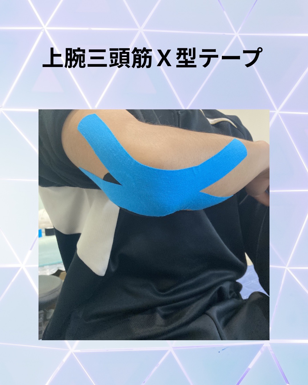 一般的なキネシオテーピングの画像